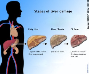 fatty-liver-cirrhosis